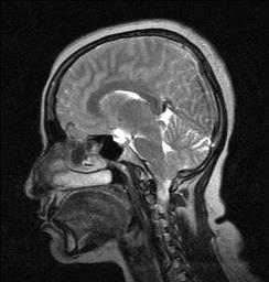 Intracranial meningioma | Image | Radiopaedia.org