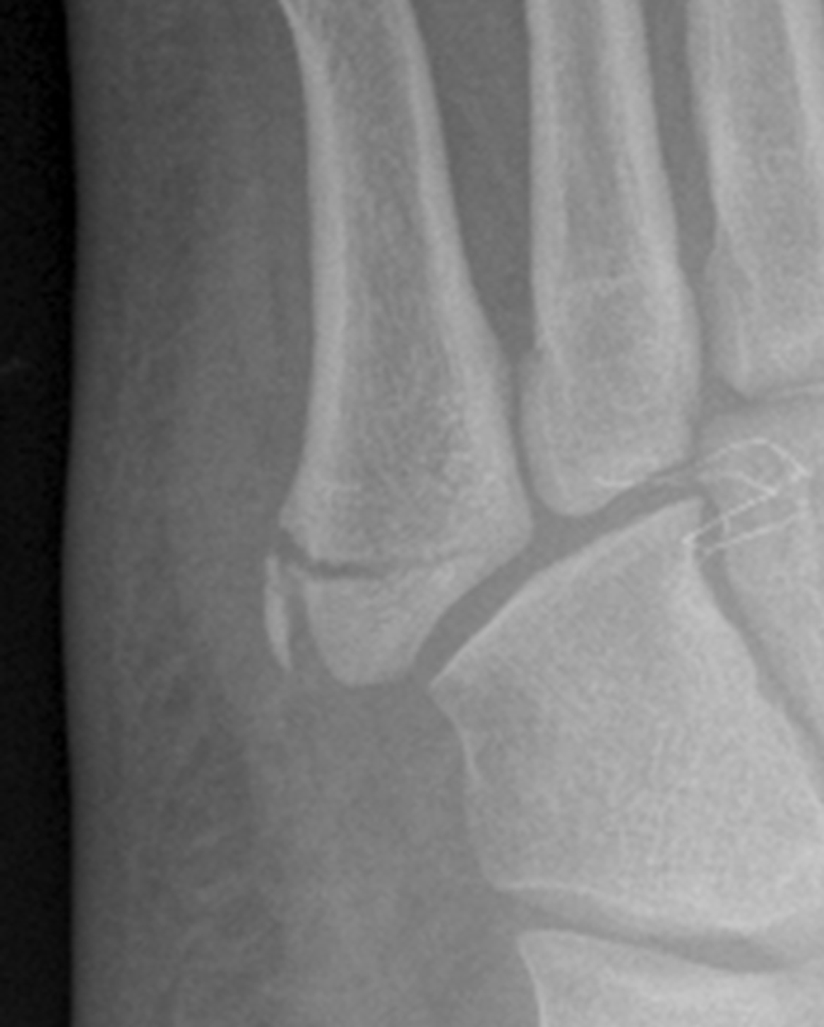 Traction apophysitis of the fifth metatarsal base with an avulsion ...