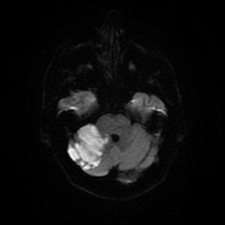 Superior Cerebellar Artery Syndrome