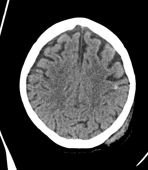 Coup-contrecoup contusion hemorrhages | Image | Radiopaedia.org