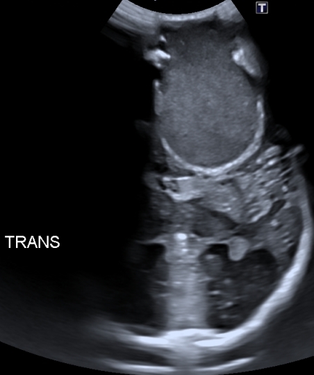 Large Intradiploic Epidermoid Cyst Image 3323