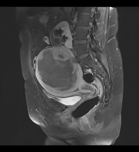 Cystic degeneration of a leiomyoma | Radiology Reference Article ...