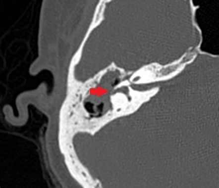 Perilymphatic fistula | Radiology Reference Article | Radiopaedia.org