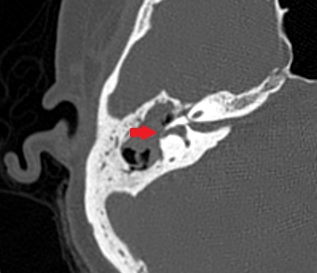 Automastoidectomy With Labyrinthine Fistula Radiology Case Radiopaedia Org