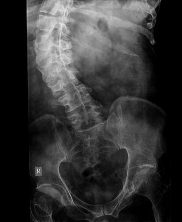 Dextroscoliosis Of Spine Radiology Case Radiopaedia Org