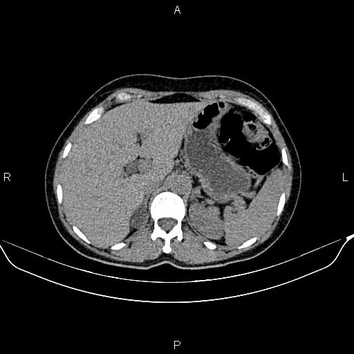 Benign Adrenal Adenoma Image 2665