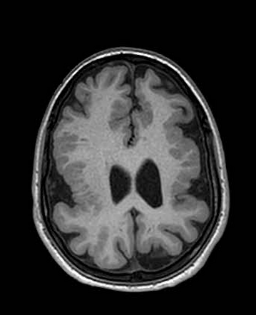 Polymicrogyria | Radiology Case | Radiopaedia.org