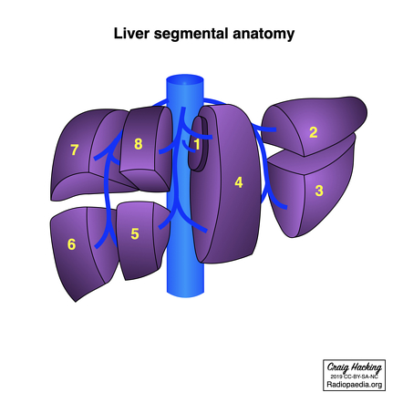 Hepatectomy And Sectionectomy Diagram Radiology Case Radiopaedia Org