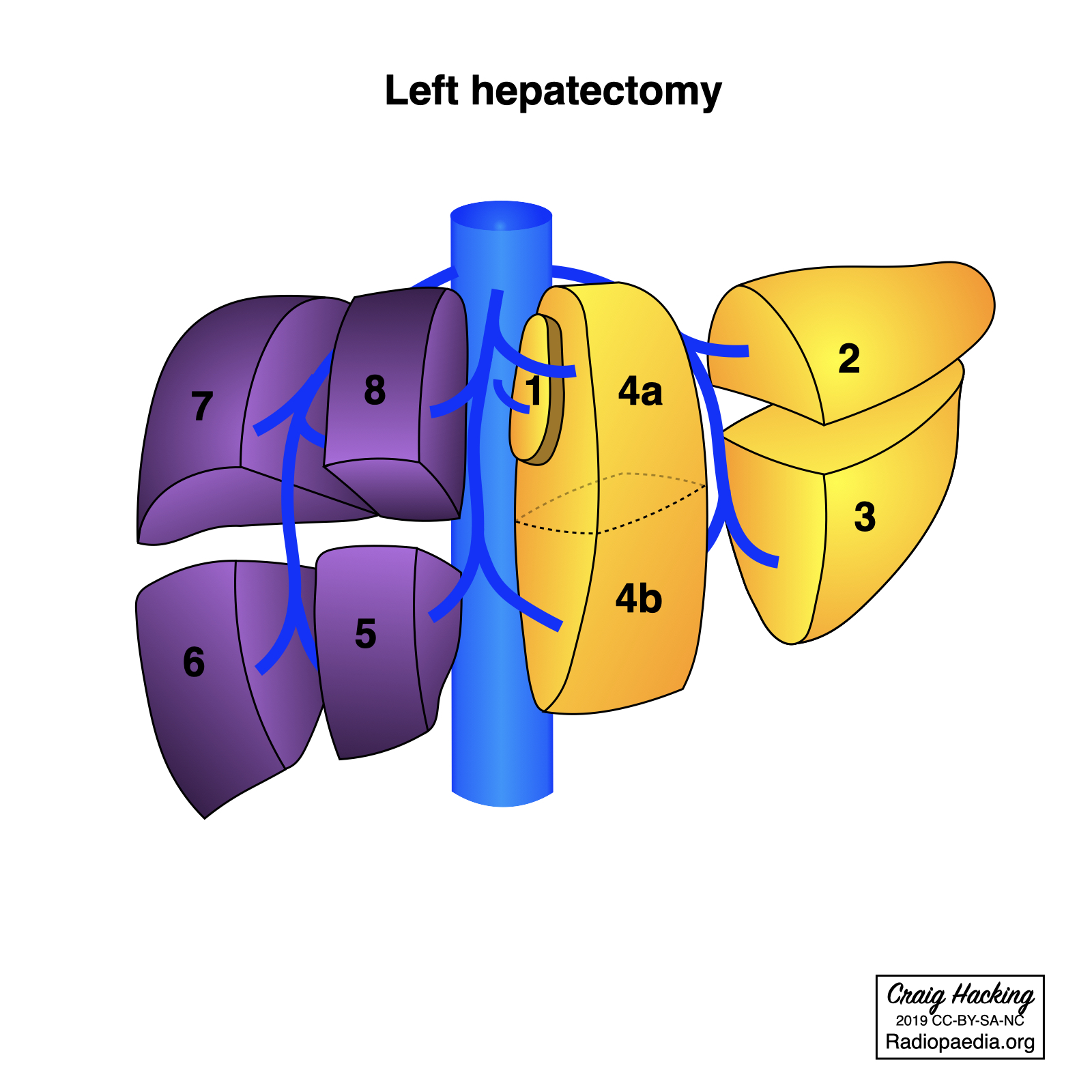 Hepatectomy And Sectionectomy (diagram) | Image | Radiopaedia.org