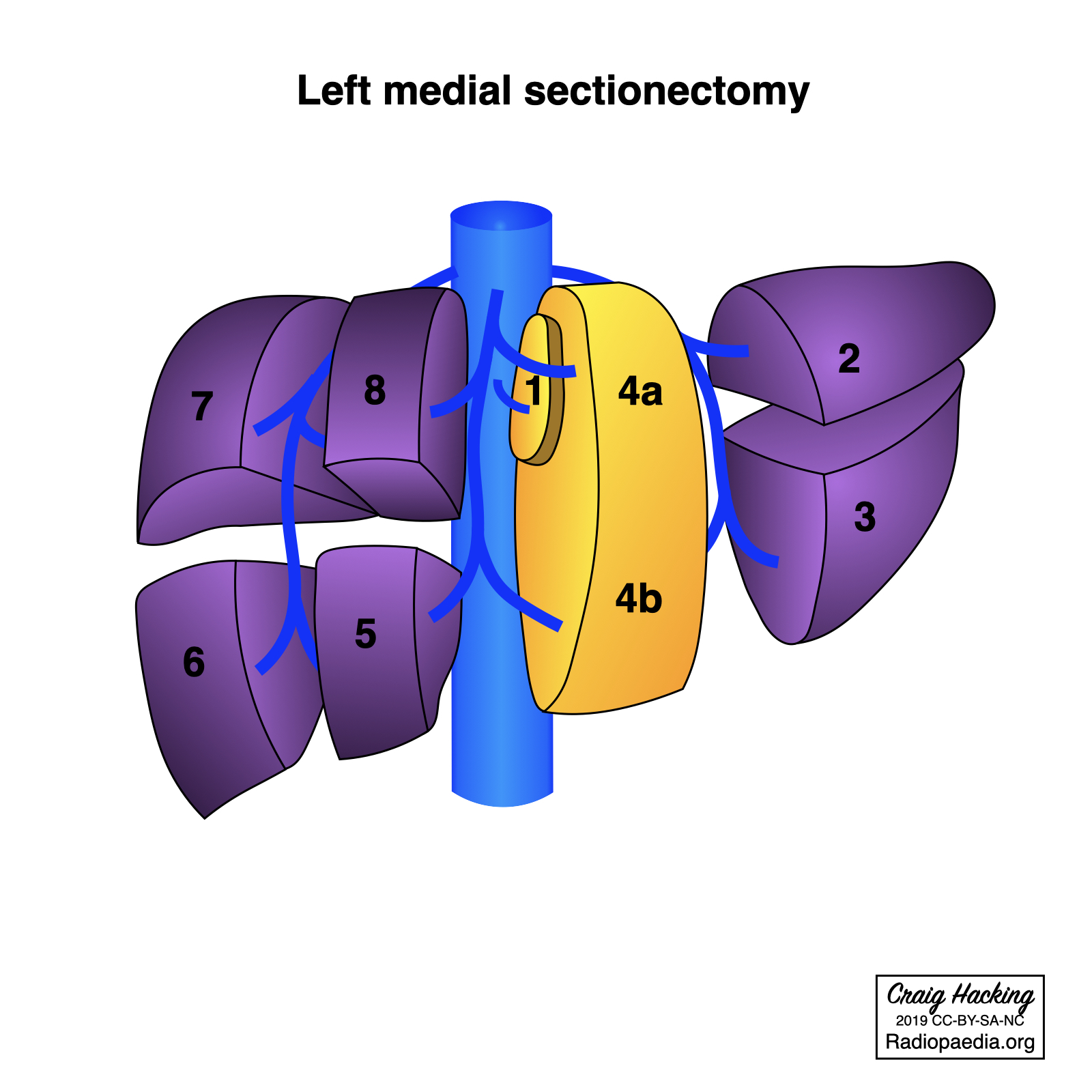 Hepatectomy And Sectionectomy Diagram Image 9446