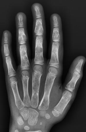 Enchondromatosis | Radiology Reference Article | Radiopaedia.org