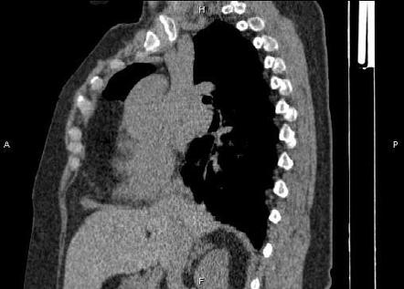 Morgagni hernia | Radiology Reference Article | Radiopaedia.org