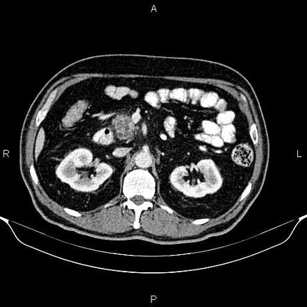 Teardrop sign (superior mesenteric vein) | Radiology Reference Article ...