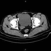 Seminal Vesicle Agenesis Radiology Reference Article Radiopaedia Org