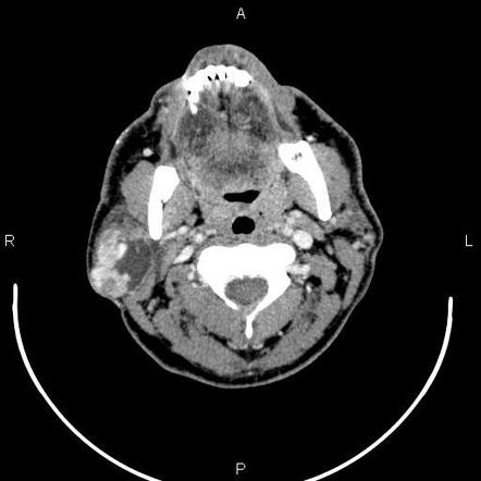 Mucoepidermoid Carcinoma Of Parotid Gland