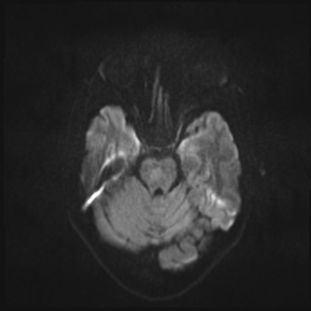 Basilar artery perforator aneurysm | Image | Radiopaedia.org