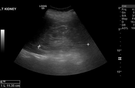 Lithium-induced renal disease | Image | Radiopaedia.org