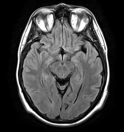 Cavernoma - frontal lobe | Image | Radiopaedia.org