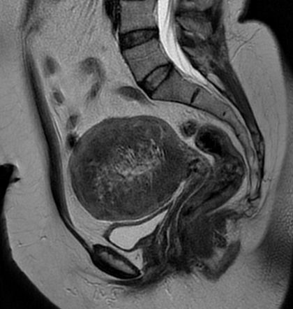 Diffuse uterine adenomyosis | Image | Radiopaedia.org