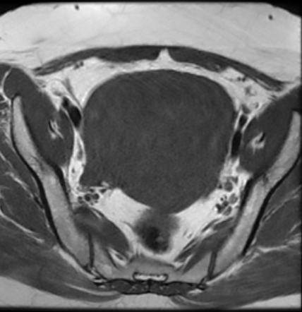 Diffuse uterine adenomyosis | Image | Radiopaedia.org