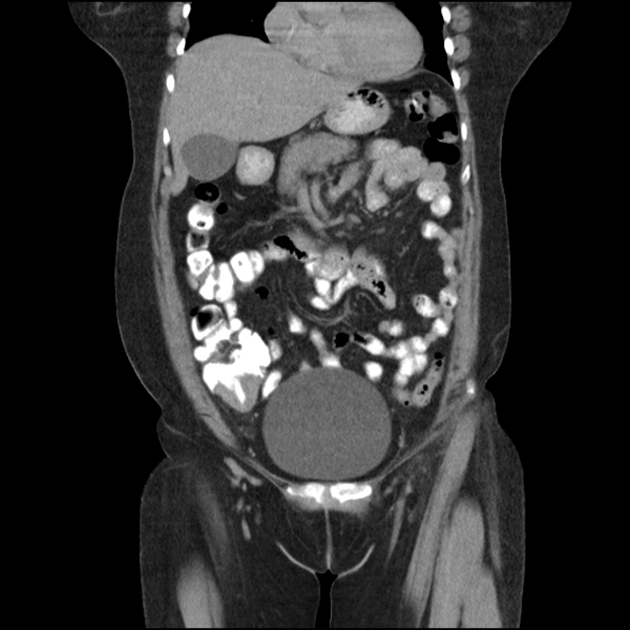 Featured image of post Epiploic Appendagitis Radiopaedia This is epiploic appendagitis by charter radiology on vimeo the home for high quality videos and the people who love them