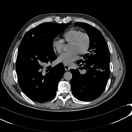 Cystic fibrosis | Image | Radiopaedia.org