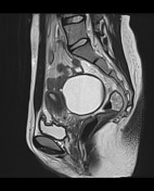 Paraovarian Cyst | Radiology Reference Article | Radiopaedia.org