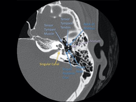 Radiology Signs Do You Know Your Temporal Bone Anatomy?, 56% OFF