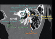 Radiopaedia - Drawing Middle ear ossicles: malleus, incus and