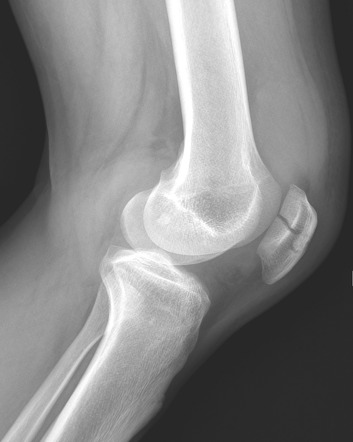 Patella fracture | Radiology Case | Radiopaedia.org