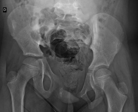 Open book pelvic fracture | Radiology Case | Radiopaedia.org