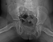 Open book pelvic injury, Radiology Reference Article