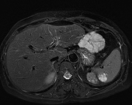 Hepatic haemangiomatosis with splenic haemangioma | Radiology Case ...