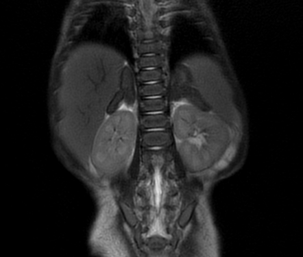 Wolman disease | Radiology Case | Radiopaedia.org