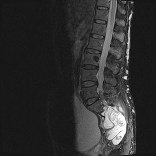 sacral-chordoma-image-radiopaedia