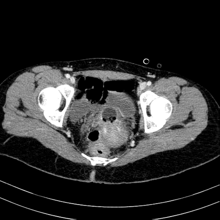 Foley catheter | Radiology Reference Article | Radiopaedia.org