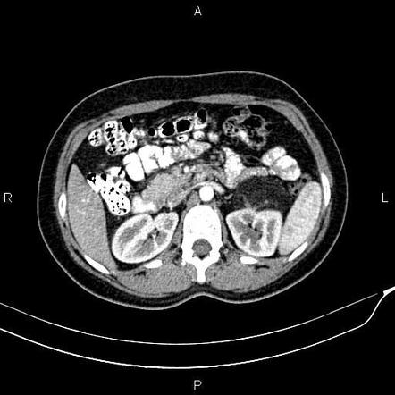 Renal angiomyolipoma | Radiology Case | Radiopaedia.org