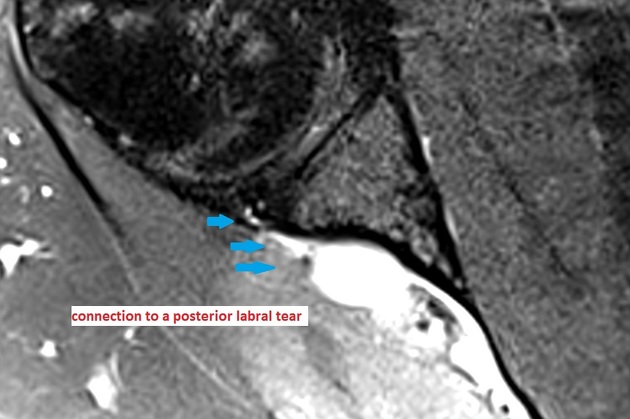 Spinoglenoid Notch Ganglion Cyst Radiology Reference Article