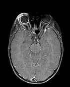 Choroidal Detachment | Radiology Reference Article | Radiopaedia.org