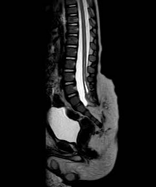 Spinal dysraphism Radiology Reference Article Radiopaedia