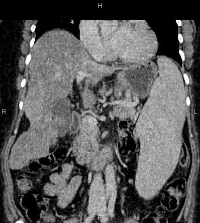 Cirrhosis | Radiology Reference Article | Radiopaedia.org