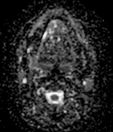 Tongue hemangioma | Image | Radiopaedia.org