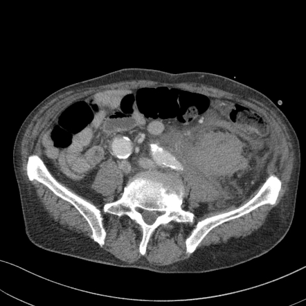 Perirenal hematoma with active extravasation after nephrostomy tube ...