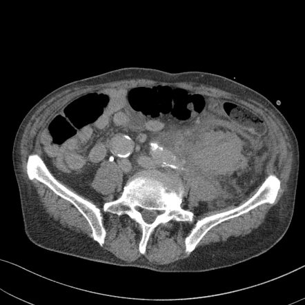 Perirenal hematoma with active extravasation after nephrostomy tube ...