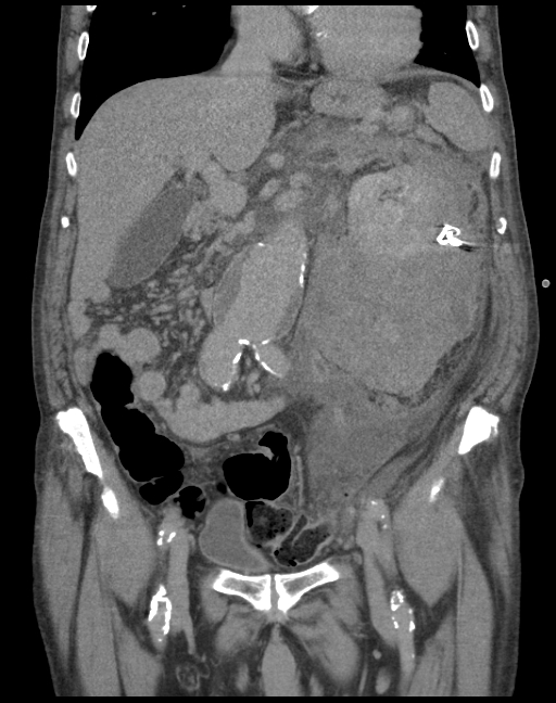 Perirenal hematoma with active extravasation after nephrostomy tube ...