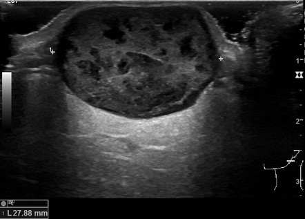 Epidermal Inclusion Cyst Parotid Region Radiology Case Radiopaedia Org