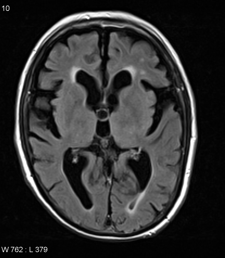 Colloid cyst | Image | Radiopaedia.org