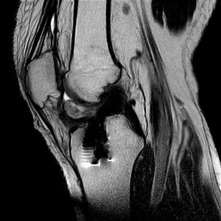 Cyclops Lesion Knee Radiology Reference Article Radiopaedia Org