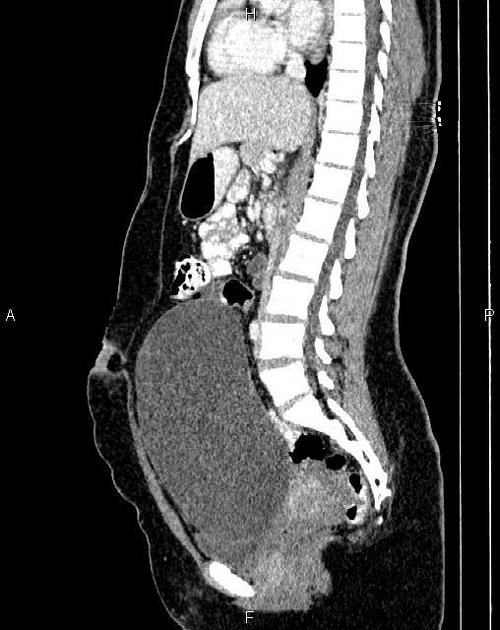 Ovarian Serous Cystadenoma Radiology Reference Article