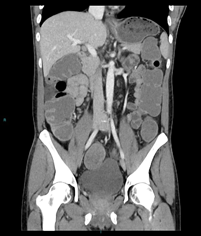 Rectal bleeding post polypectomy | Image | Radiopaedia.org